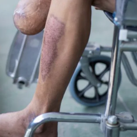 Nógv færri amputatiónir í Føroyum orsakað av gransking